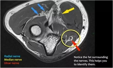 肘关节常见疾病的MRI影像图谱，赶快收藏！