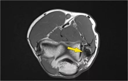 肘关节常见疾病的MRI影像图谱，赶快收藏！