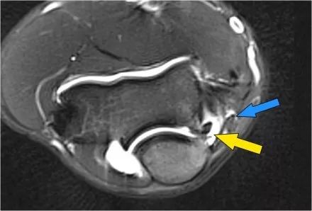 肘关节常见疾病的MRI影像图谱，赶快收藏！