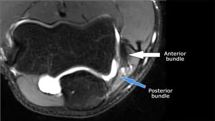 肘关节常见疾病的MRI影像图谱，赶快收藏！