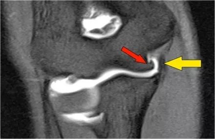 肘关节常见疾病的MRI影像图谱，赶快收藏！