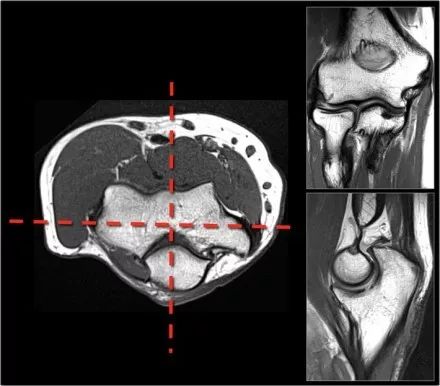 肘关节常见疾病的MRI影像图谱，赶快收藏！