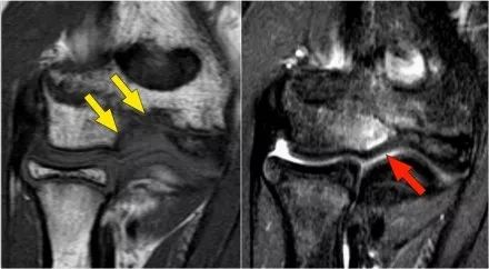 肘关节常见疾病的MRI影像图谱，赶快收藏！