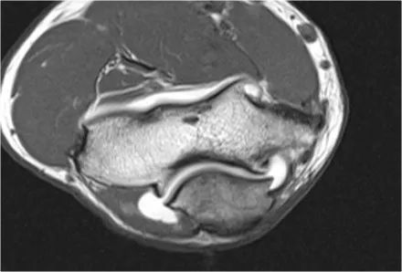 肘关节常见疾病的MRI影像图谱，赶快收藏！