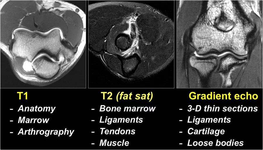 肘关节常见疾病的MRI影像图谱，赶快收藏！