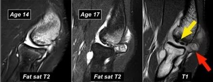 肘关节常见疾病的MRI影像图谱，赶快收藏！