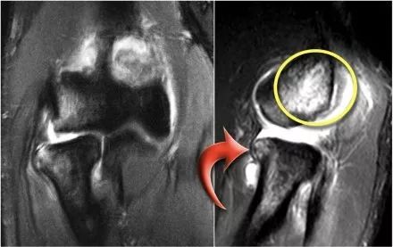 肘关节常见疾病的MRI影像图谱，赶快收藏！