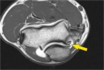 肘关节常见疾病的MRI影像图谱，赶快收藏！