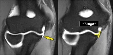 肘关节常见疾病的MRI影像图谱，赶快收藏！