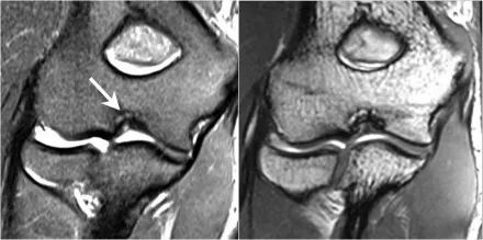 肘关节常见疾病的MRI影像图谱，赶快收藏！