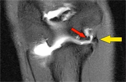 肘关节常见疾病的MRI影像图谱，赶快收藏！