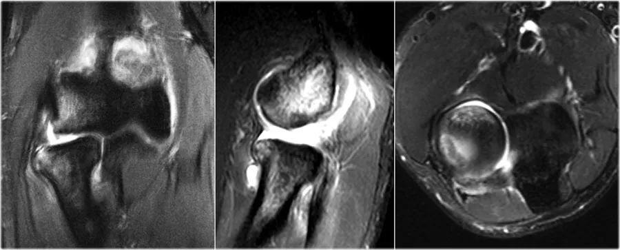 肘关节常见疾病的MRI影像图谱，赶快收藏！