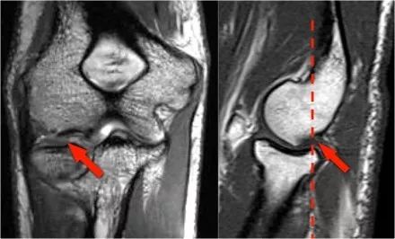 肘关节常见疾病的MRI影像图谱，赶快收藏！