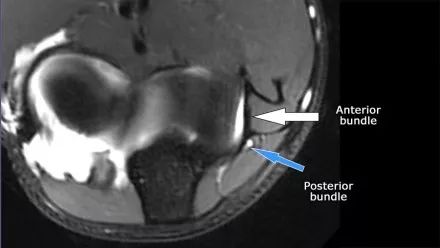 肘关节常见疾病的MRI影像图谱，赶快收藏！