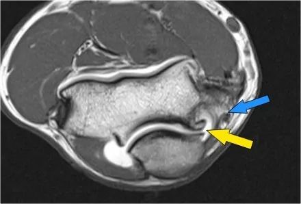 肘关节常见疾病的MRI影像图谱，赶快收藏！