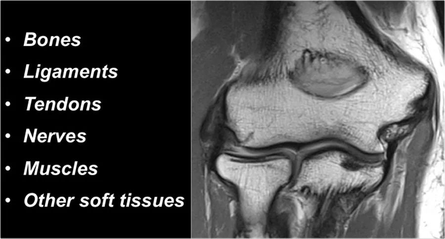 肘关节常见疾病的MRI影像图谱，赶快收藏！