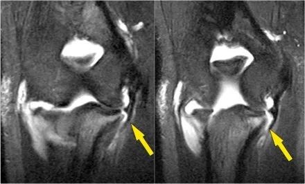肘关节常见疾病的MRI影像图谱，赶快收藏！