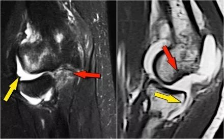 肘关节常见疾病的MRI影像图谱，赶快收藏！