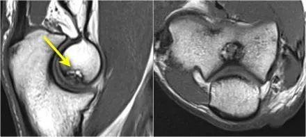 肘关节常见疾病的MRI影像图谱，赶快收藏！