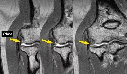 肘关节常见疾病的MRI影像图谱，赶快收藏！