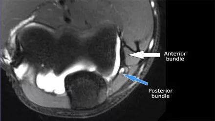 肘关节常见疾病的MRI影像图谱，赶快收藏！
