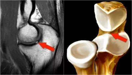 肘关节常见疾病的MRI影像图谱，赶快收藏！