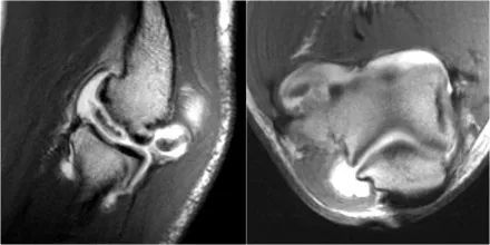 肘关节常见疾病的MRI影像图谱，赶快收藏！