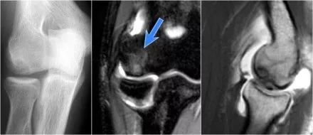 肘关节常见疾病的MRI影像图谱，赶快收藏！