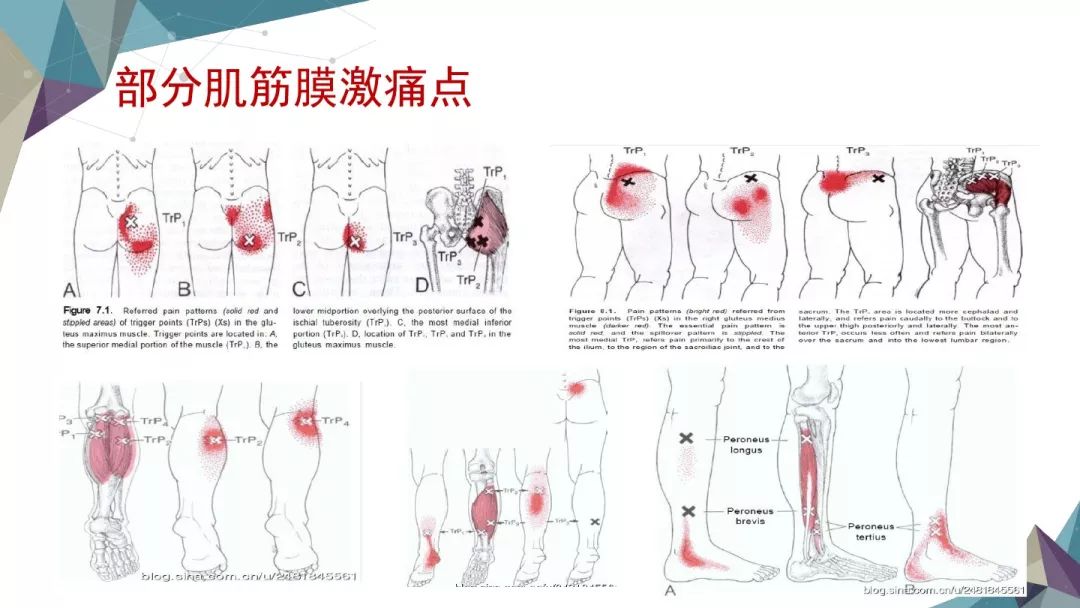 一文读懂：肌筋膜疼痛综合征