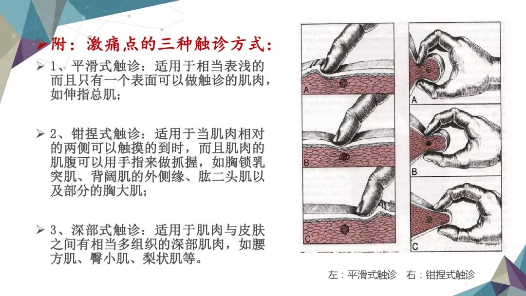 一文读懂：肌筋膜疼痛综合征