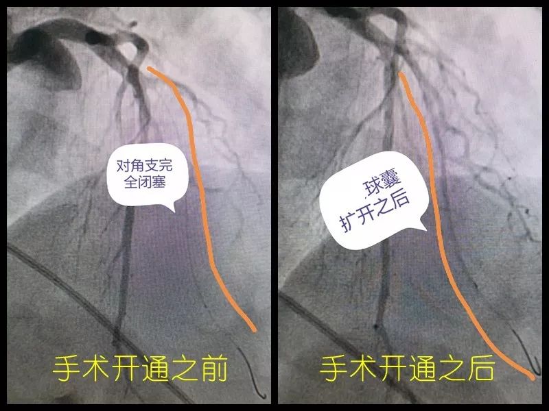 心梗患者用命换来一个字，这个字要钱又要命！