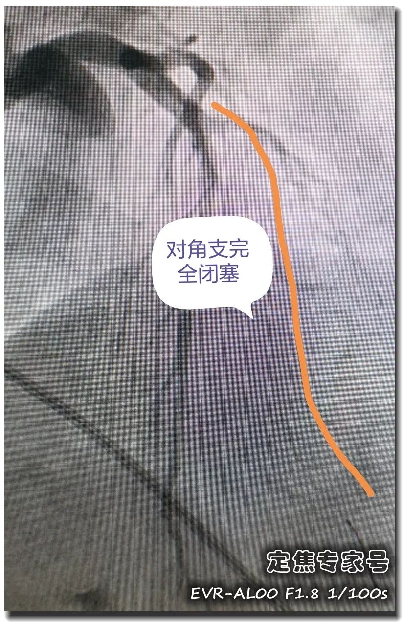 心梗患者用命换来一个字，这个字要钱又要命！