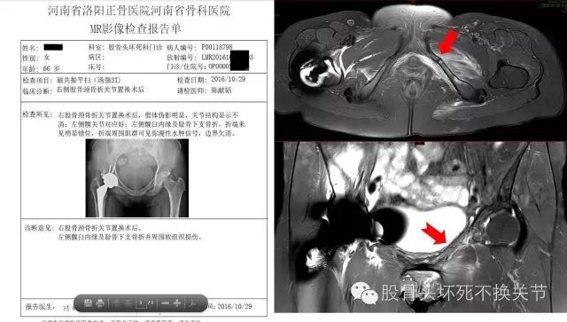 股骨头坏死怎样做检查？读完本文你就掌握！