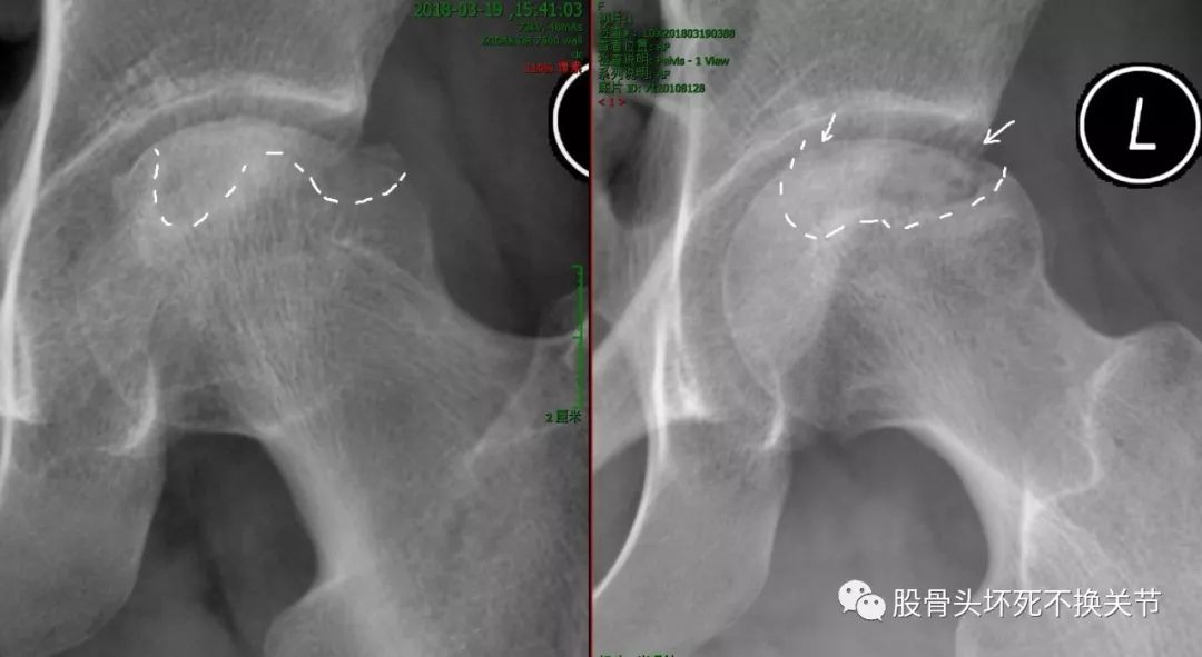 股骨头坏死原因剖析，值得一看！