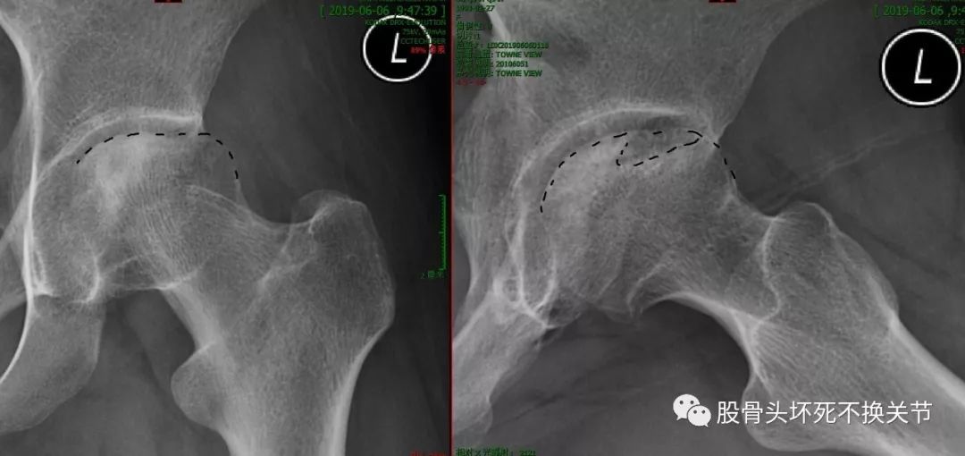 股骨头坏死原因剖析，值得一看！