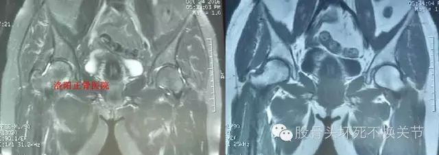 股骨头坏死怎样做检查？读完本文你就掌握！