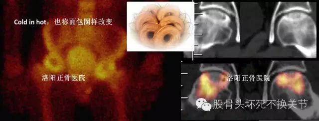 股骨头坏死怎样做检查？读完本文你就掌握！