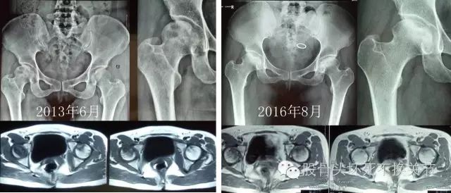 股骨头坏死怎样做检查？读完本文你就掌握！