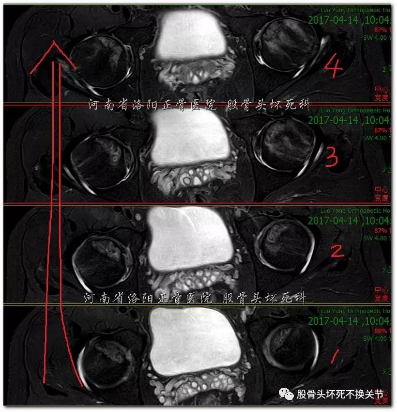 股骨头坏死是如何一步步演变而来的？