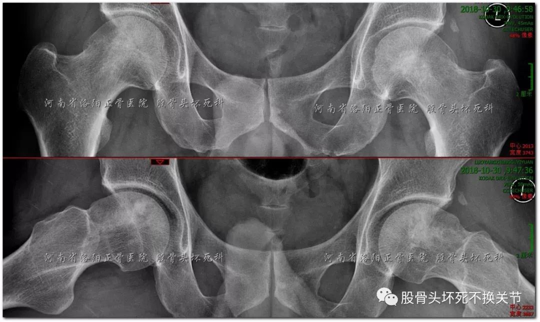 股骨头坏死是如何一步步演变而来的？