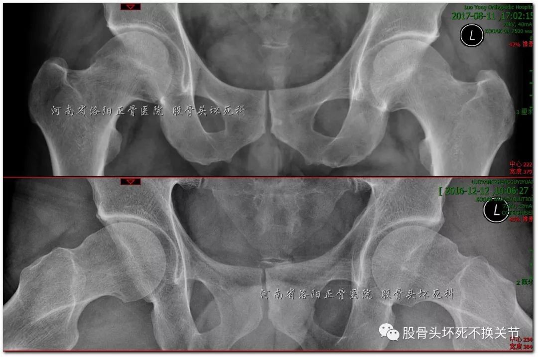 股骨头坏死是如何一步步演变而来的？