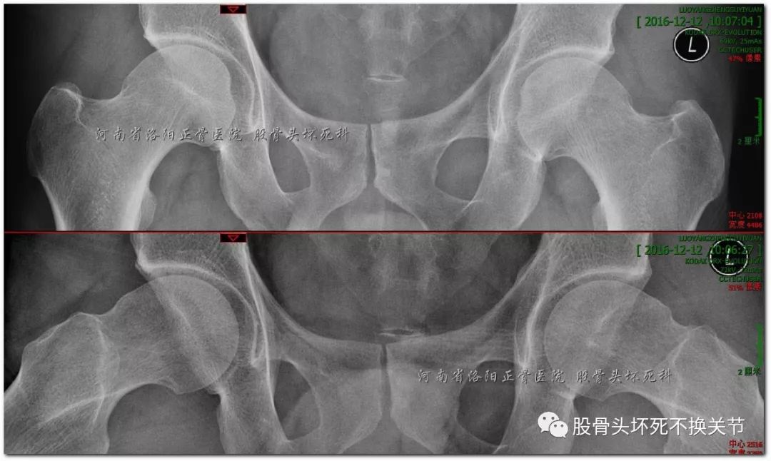 股骨头坏死是如何一步步演变而来的？