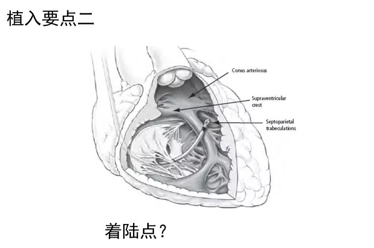 植入临时起搏器方法与技巧