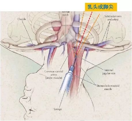 植入临时起搏器方法与技巧