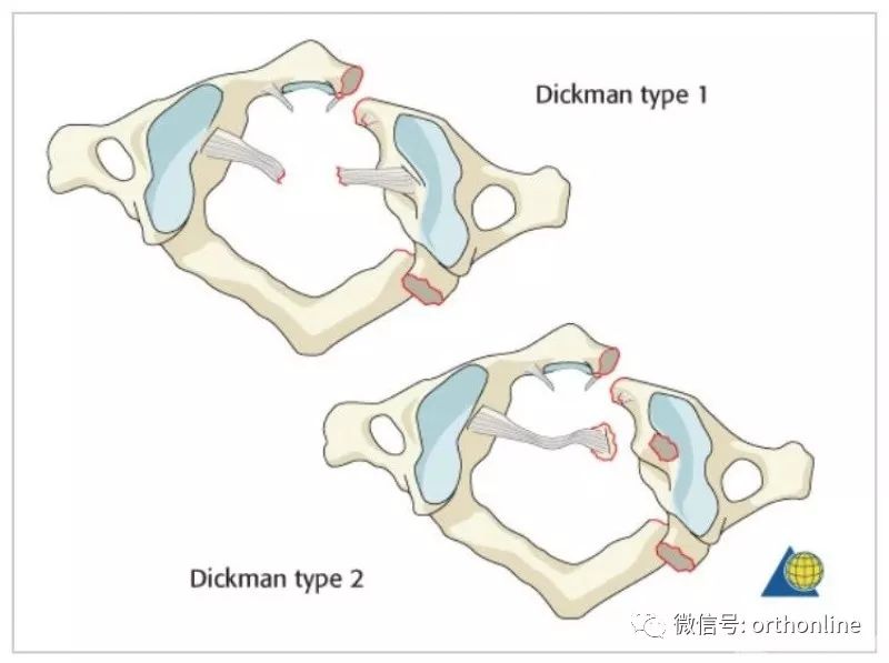 脊柱查房写病历必备宝典：全脊柱骨折AO分型图谱