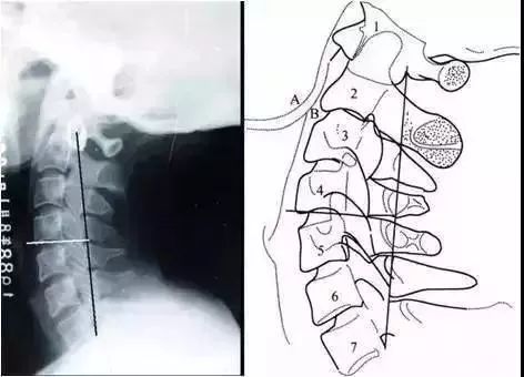 这样看颈椎X线，你也能成为高手！