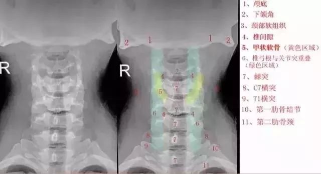 这样看颈椎X线，你也能成为高手！