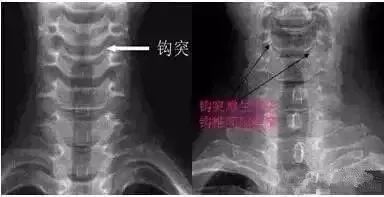 这样看颈椎X线，你也能成为高手！