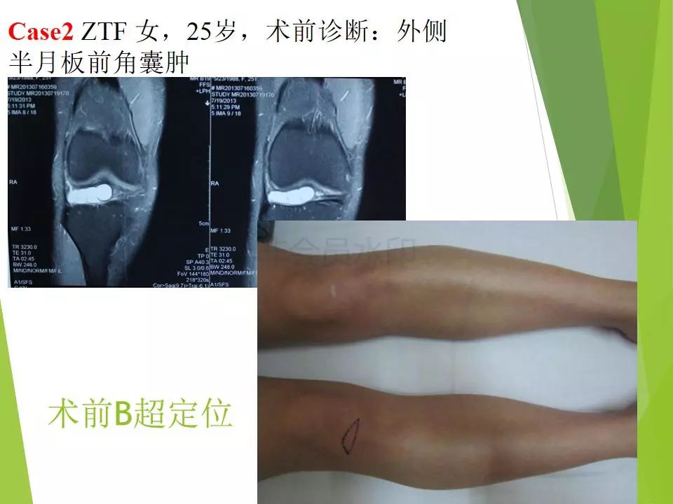 半月板损伤关节内及关节外各种缝合技术及应用