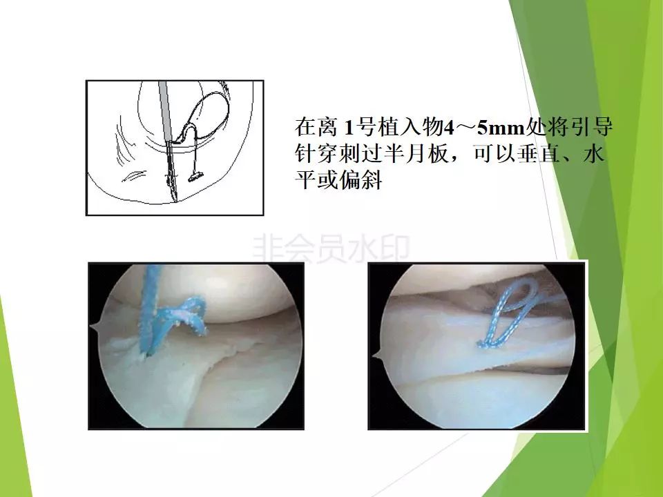 半月板损伤关节内及关节外各种缝合技术及应用
